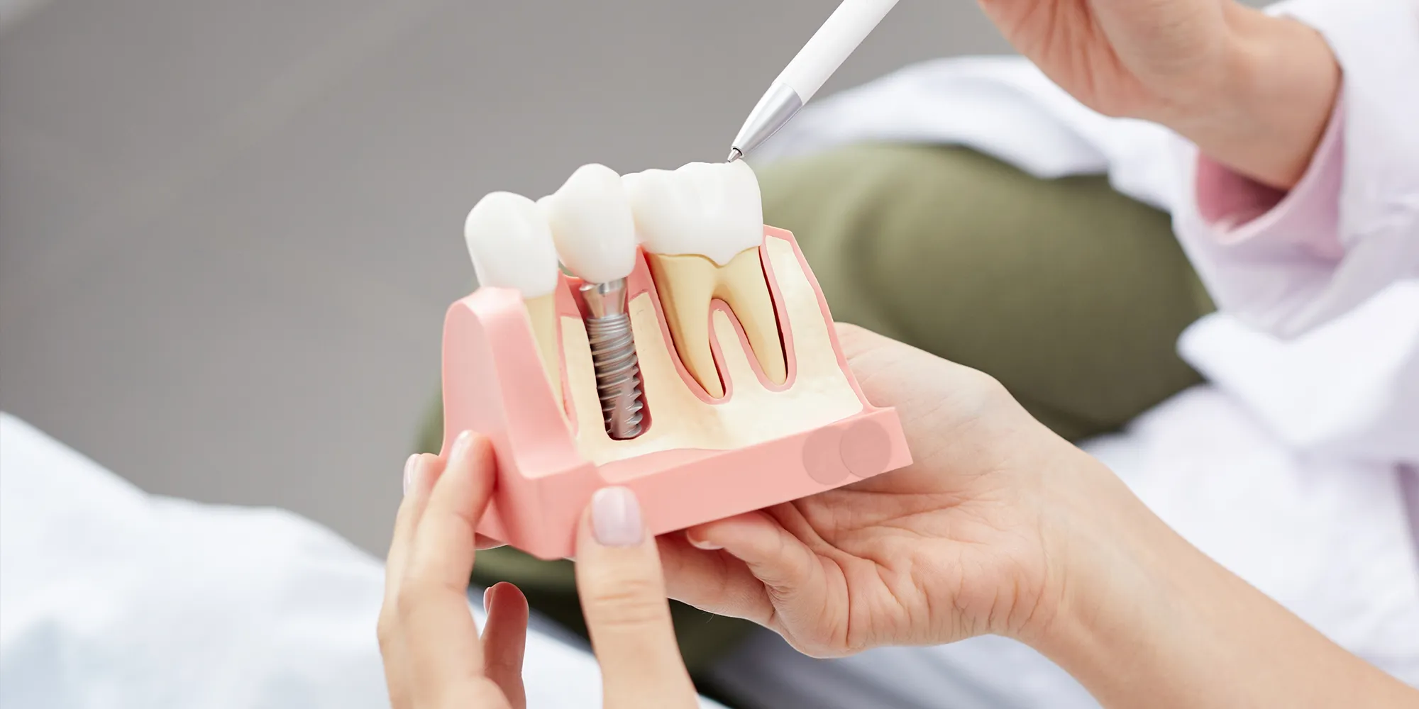 Dental Bridge atau Implan Gigi: Solusi Jangka Panjang Terbaik untuk mengganti Gigi Hilang?