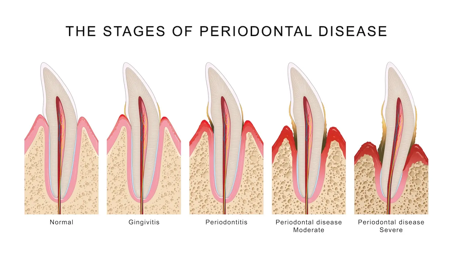 35695d6b734516b62cdfa4e3edd8c61a.webp Gusi bengkak dan gusi berdarah bukanlah kondisi sepele, melainkan tanda awal adanya penyakit gusi seperti gingivitis atau periodontitis.