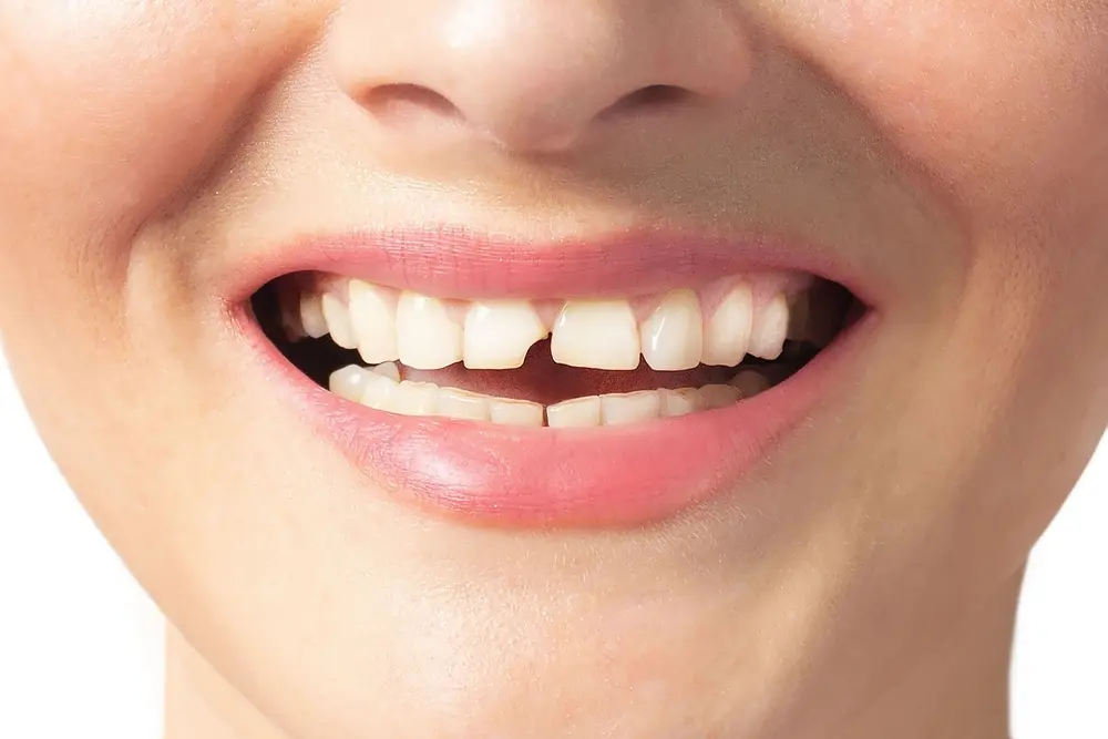 Aesthetic Solutions for Chipped or Broken Front Teeth: Composite Bonding, Veneers, or Crowns?