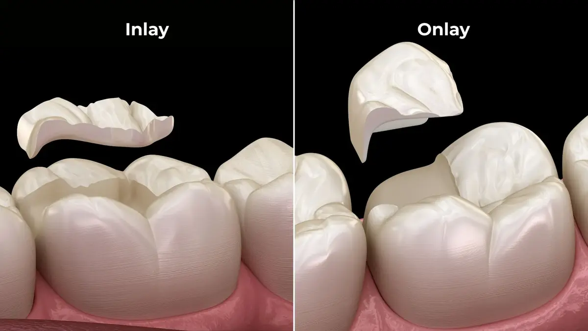 Inlay dan onlay merupakan jenis restorasi tidak langsung (indirect restoration) yang dibuat secara presisi di laboratorium untuk menggantikan struktur gigi yang hilang akibat karies atau fraktur