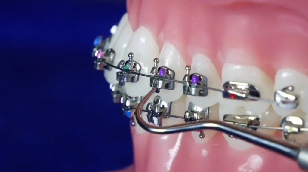 Behel Damon: Sistem Self-Ligating yang Diklaim Lebih Cepat dan Nyaman — Fakta atau Mitos?