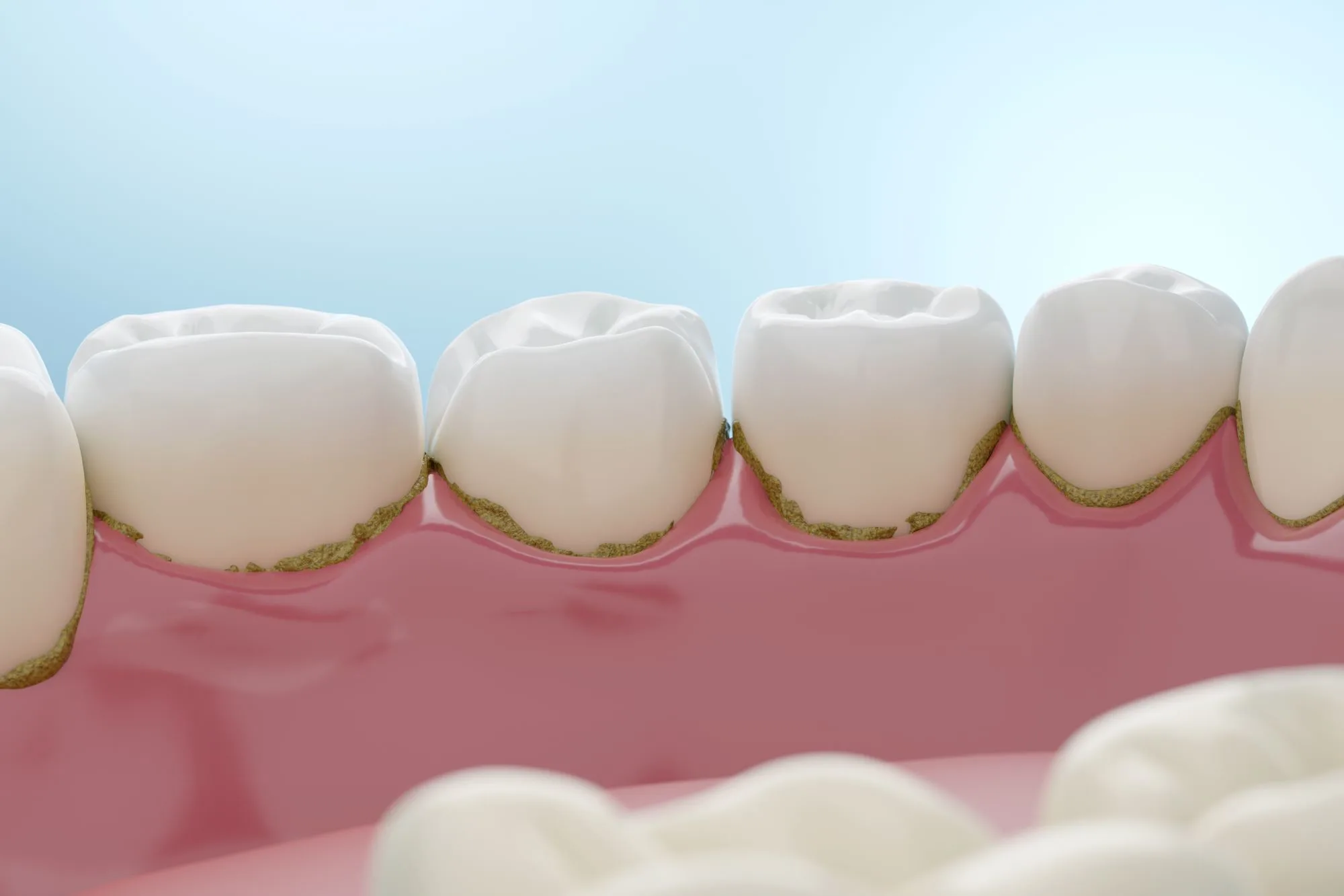 Does Tartar Cause Bad Breath? Understanding the Causes & Solutions