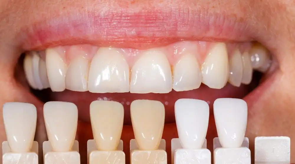 Efek Samping Veneer Gigi: Risiko yang Perlu Dipahami sebelum Memilih Smile Makeover