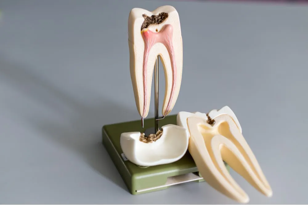 Root Canal Treatment: Saving an Infected Tooth Without Extraction