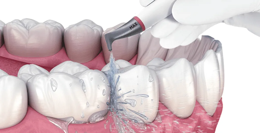 Does Teeth Scaling Hurt? Here's What It Really Feels Like and How to Make It More Comfortable