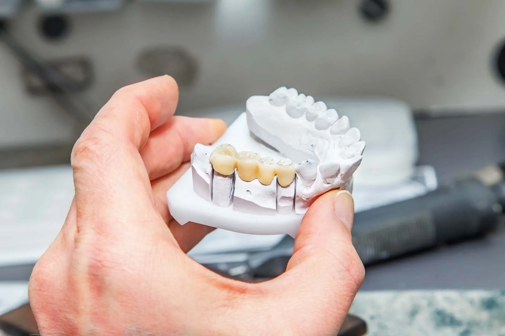 Permanent Tooth Replacement: Dental Bridge or Dental Implant? A Guide to Choosing the Best Solution