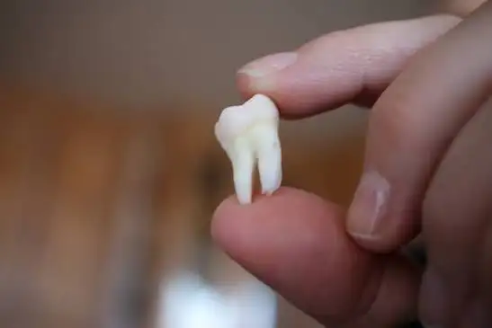 Should Wisdom Teeth Always Be Removed? Signs You Should Have Checked by a Dentist